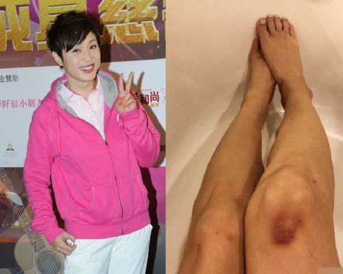 陳法蓉晒傷腳，網民都戥她痛。陳法蓉微博圖片