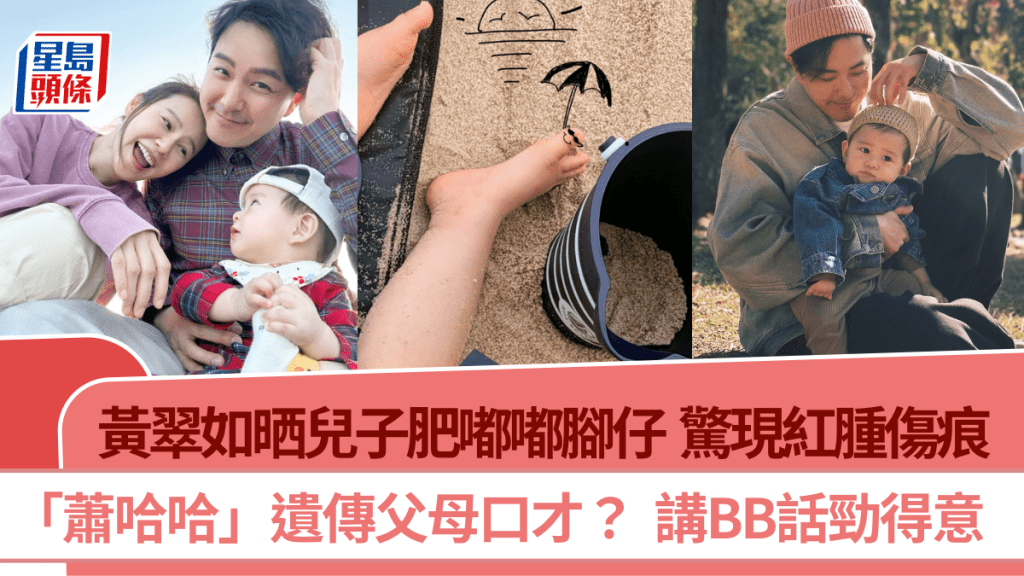 黃翠如晒兒子肥嘟嘟腳仔  驚現紅腫傷痕網民嗌心痛  蕭哈哈被阿媽點評皮粗肉厚