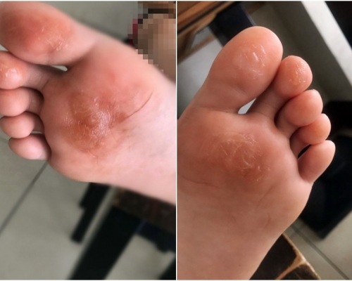 多名學生的腳底起水泡,甚至破皮流血。網圖