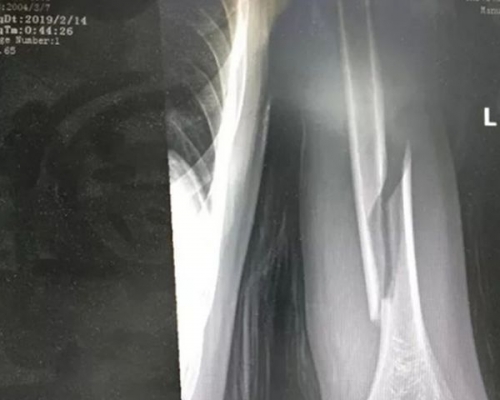 醫生通檢查後,發現少年的肱骨為螺旋性骨折。網圖