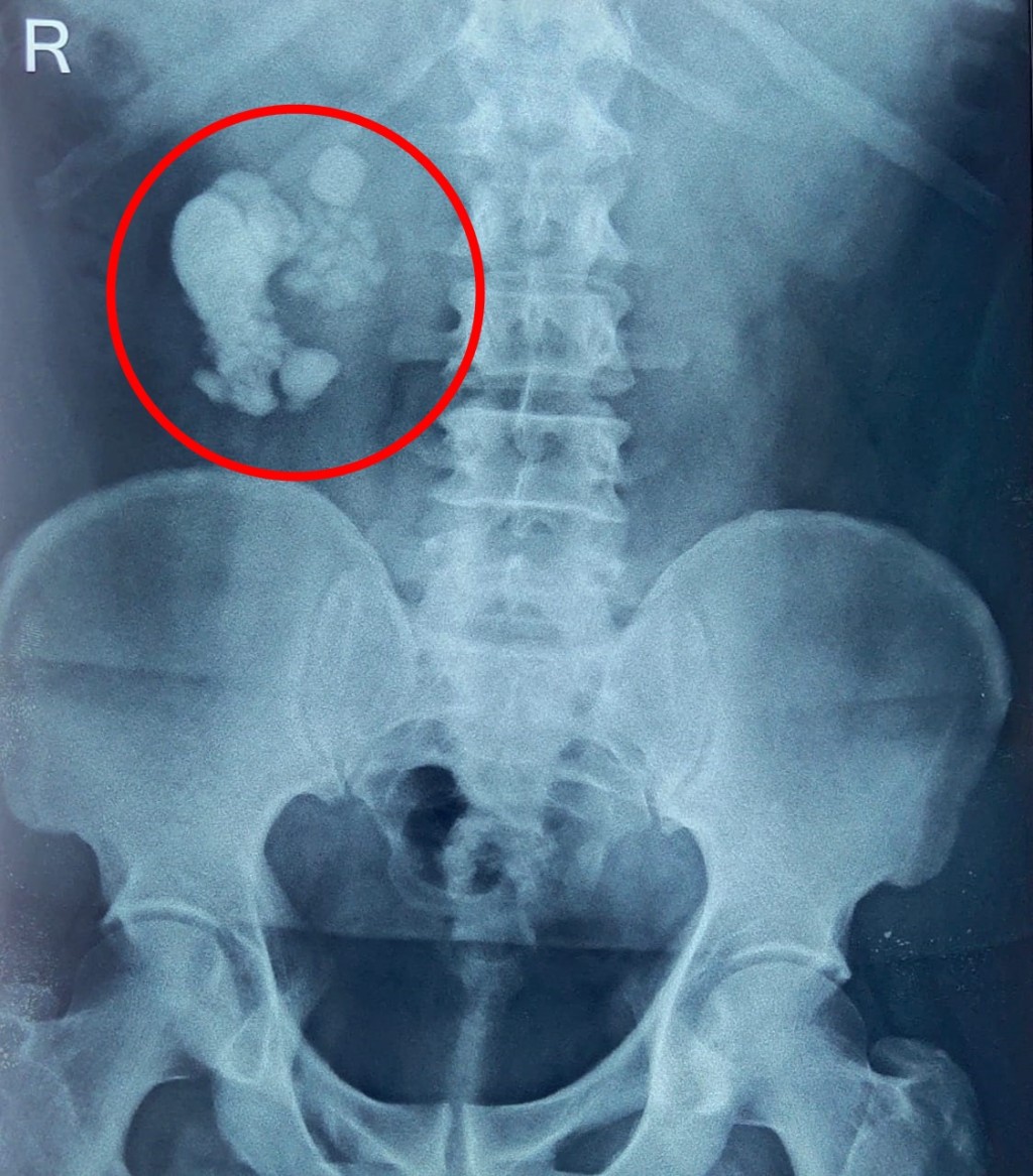 從X光片可見,病人有大量腎石(紅圈)。互聯網圖片