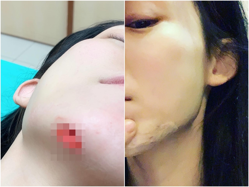 范瑋琪下巴受傷，需要縫15針。范瑋琪fb圖片