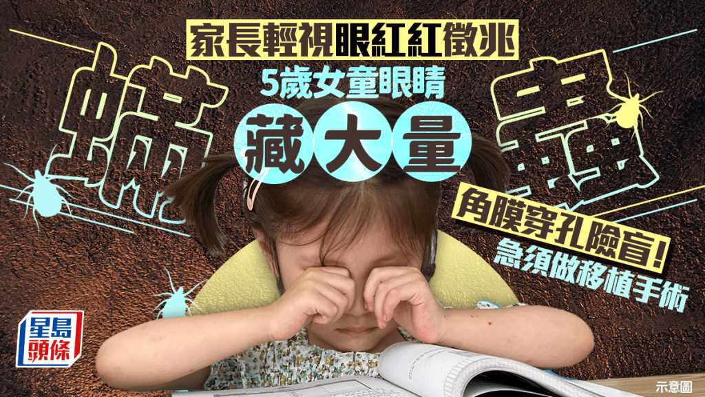 家長輕視眼紅紅徵兆！5歲女童眼睛藏大量蟎蟲角膜穿孔險盲 急須做移植手術