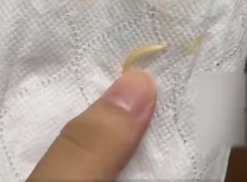 消費者稱在臭寶螺螄粉中吃出疑似腳趾甲。