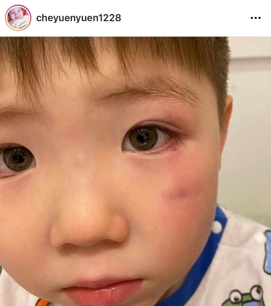 BBQ日前Kick親,搞到左眼被硬物撞到瘀晒!