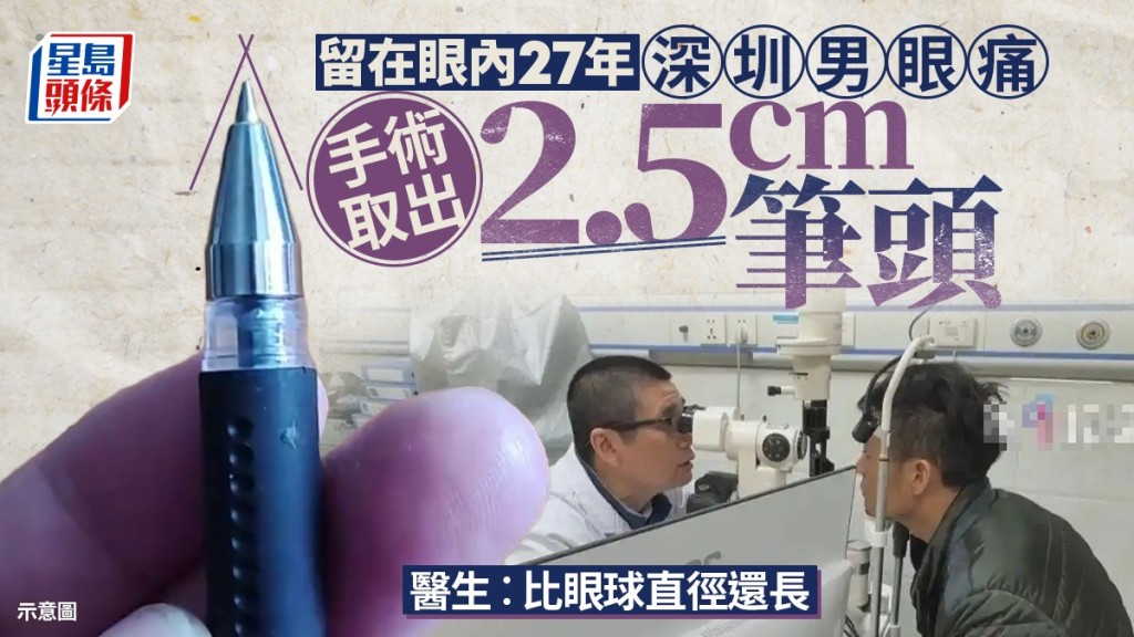 深圳男眼痛就醫取出27年前遺留原子筆頭，長2.5cm比眼球直徑大。