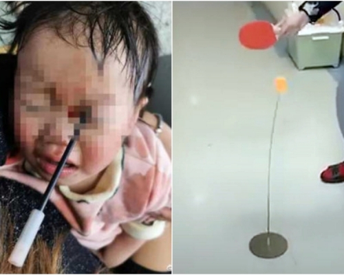 內地3歲女童玩彈力乒乓球，不慎讓不鏽鋼軟軸直插左眼，未來恐損視力。網上圖片