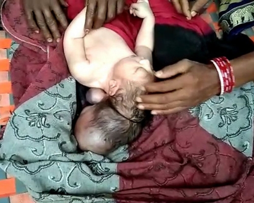 印度婦誕3頭女嬰。網圖