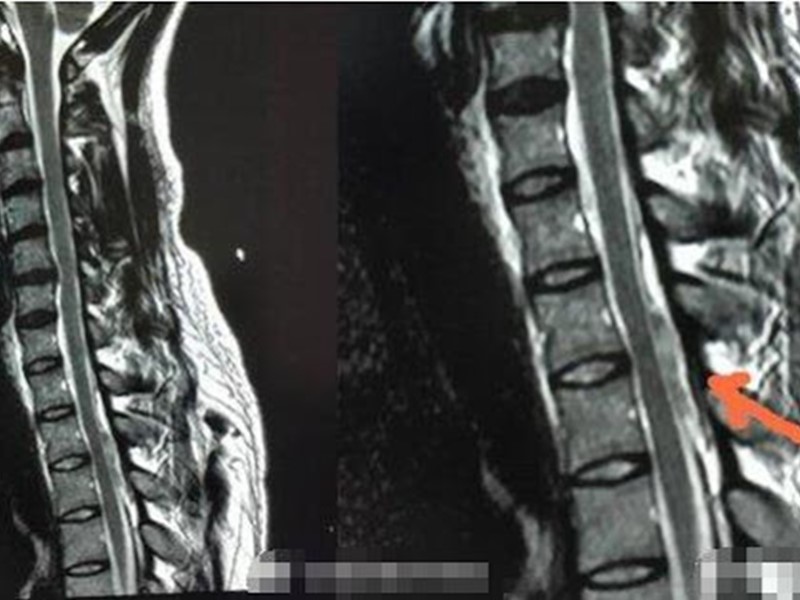医生估计是做掌上压时增加腹压引致血管破裂。网图