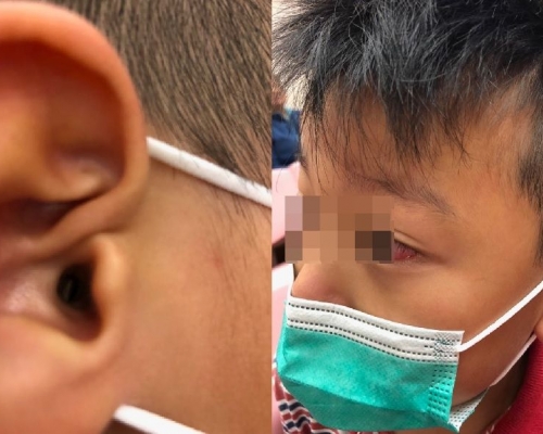 軒仔疑遭同學欺凌，不但被掌摑，更被人用鉛筆插耳及手指插眼。
