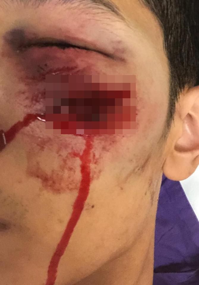 男子被橡膠彈擦面而過，血痕至少3厘米長。網圖