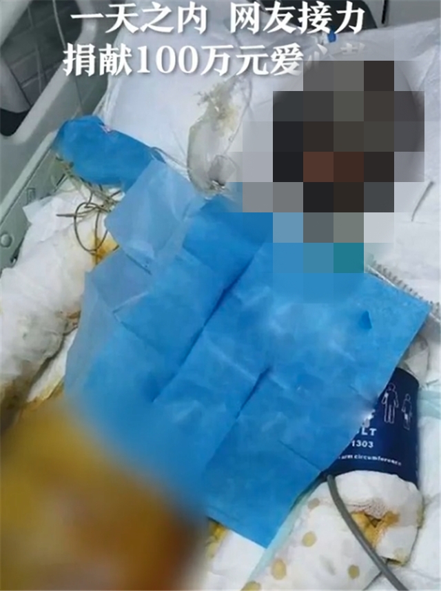 卓瑪拉姆全身嚴重燒傷病情危急。網圖