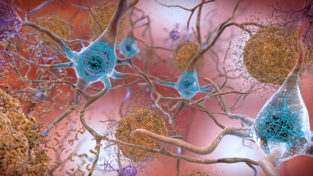 插圖描繪受阿茲海默病影響的大腦中的細胞，異常水平的 β-澱粉樣蛋白聚集在一起形成褐色斑塊，聚集在神經元之間並破壞細胞功能。 美聯社