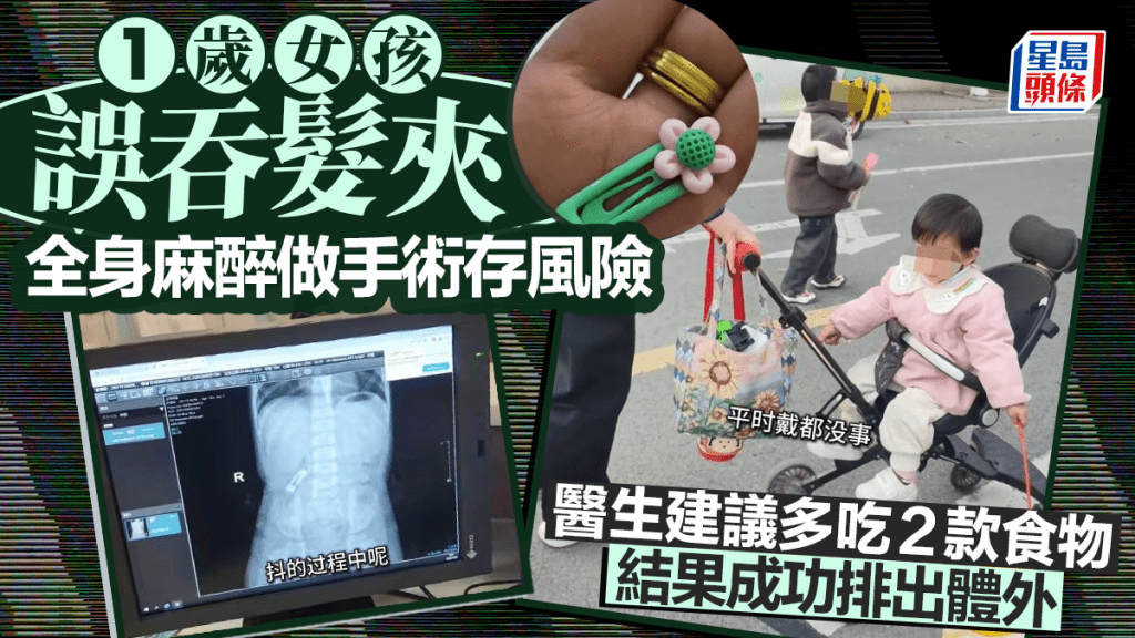 安徽1歲女吞3厘米髮夾翻白眼  靠食韭菜成功屙出