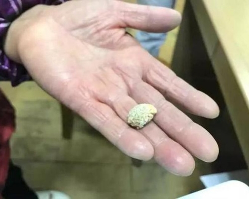 大媽咳出原本要用手術取出的結石。網圖