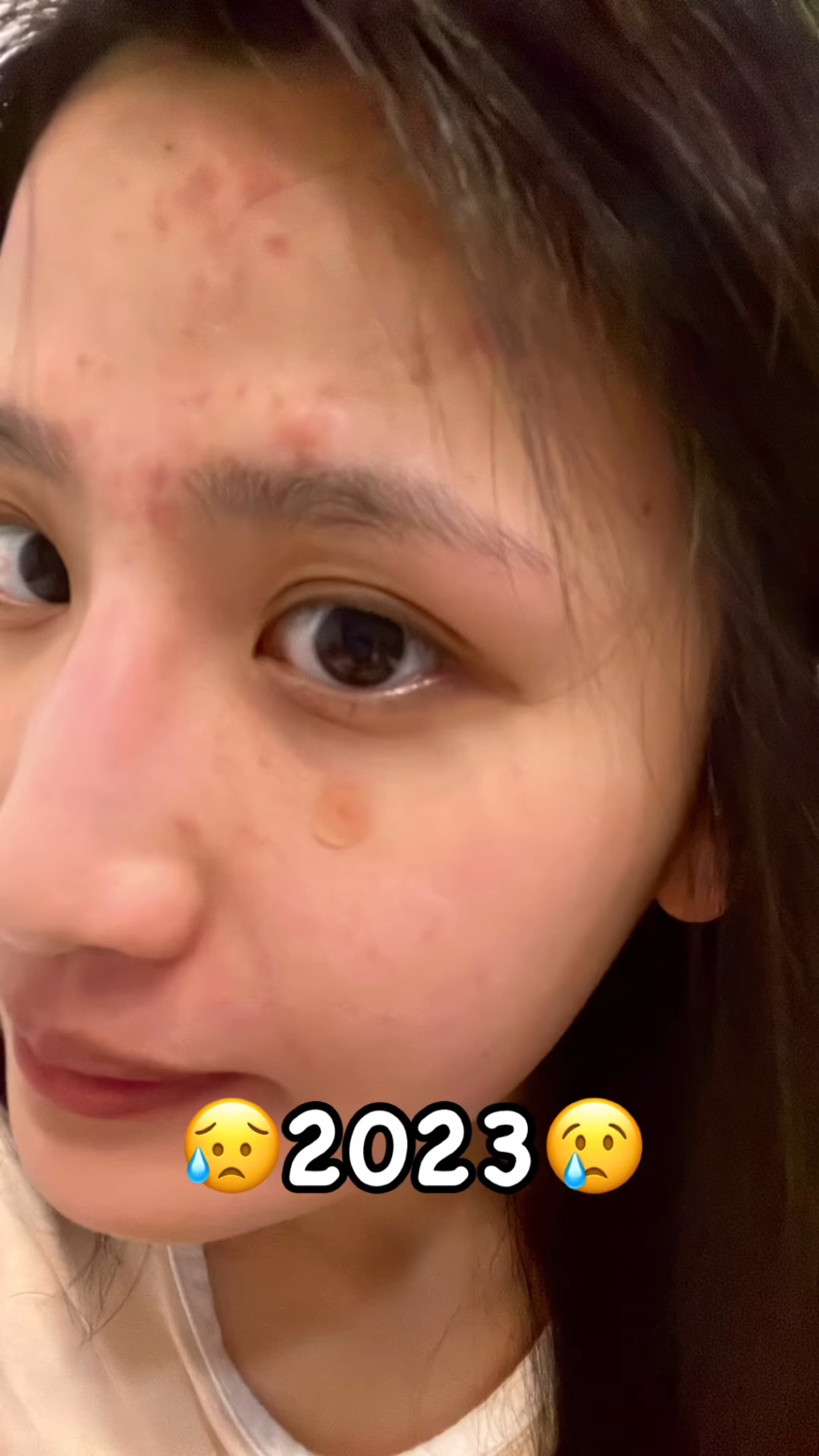 林芊妤今日（31日）在IG贴出一段影片，见到她卸妆后脸上布满暗疮印。
