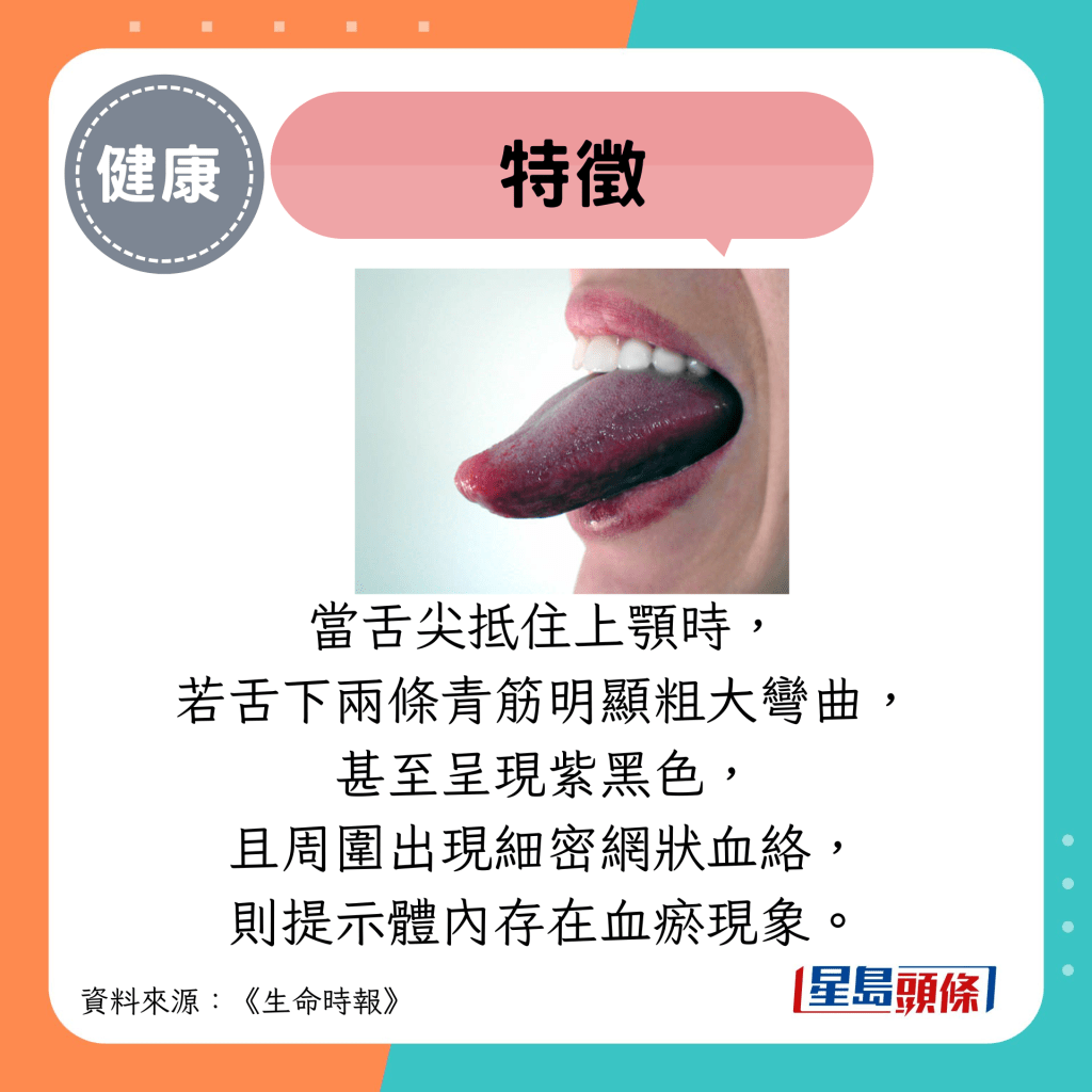 特征：当舌尖抵住上颚时， 若舌下两条青筋明显粗大弯曲， 甚至呈现紫黑色， 且周围出现细密网状血络， 则提示体内存在血瘀现象。