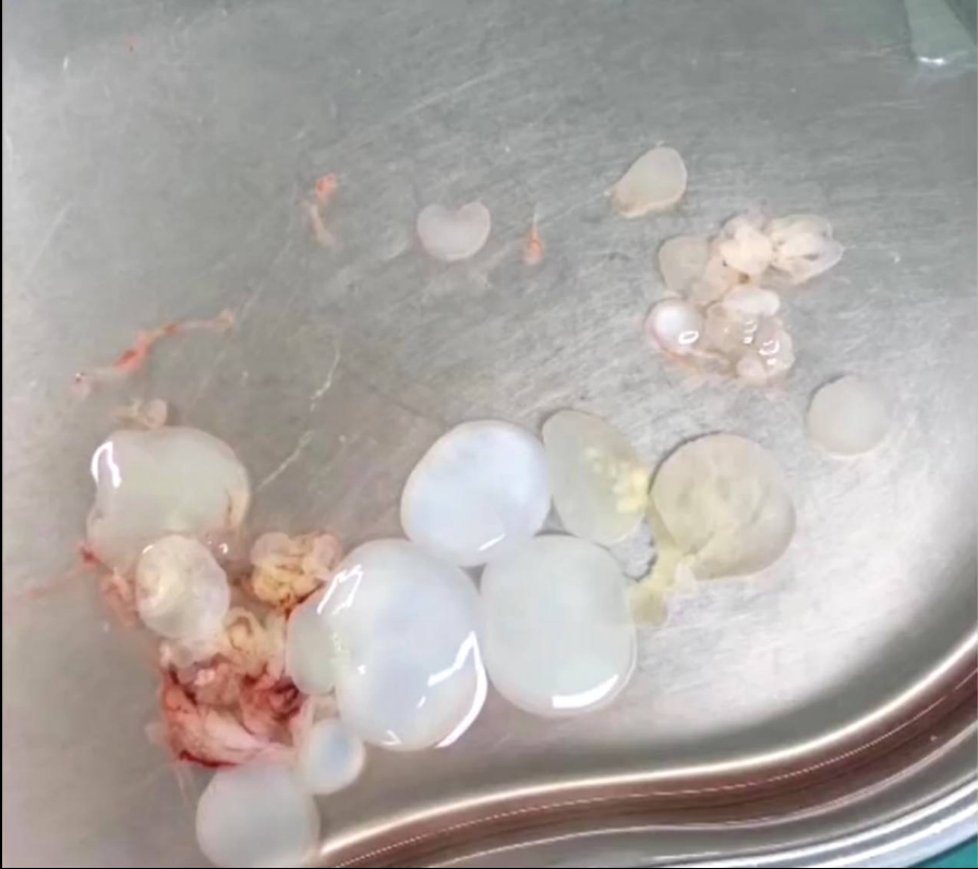 葡萄串狀的腦囊蟲卵，最大直徑1公分，數量多達30多個。（網圖）