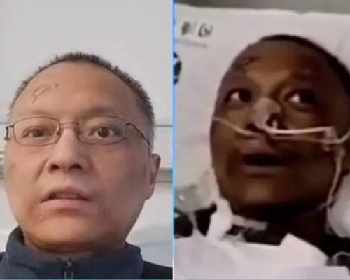 武漢兩名感染新冠肺炎的醫生面容變黑，引發關注，其中一名醫生康復不少更接受採訪，皮革顏色明顯改善。(網圖)