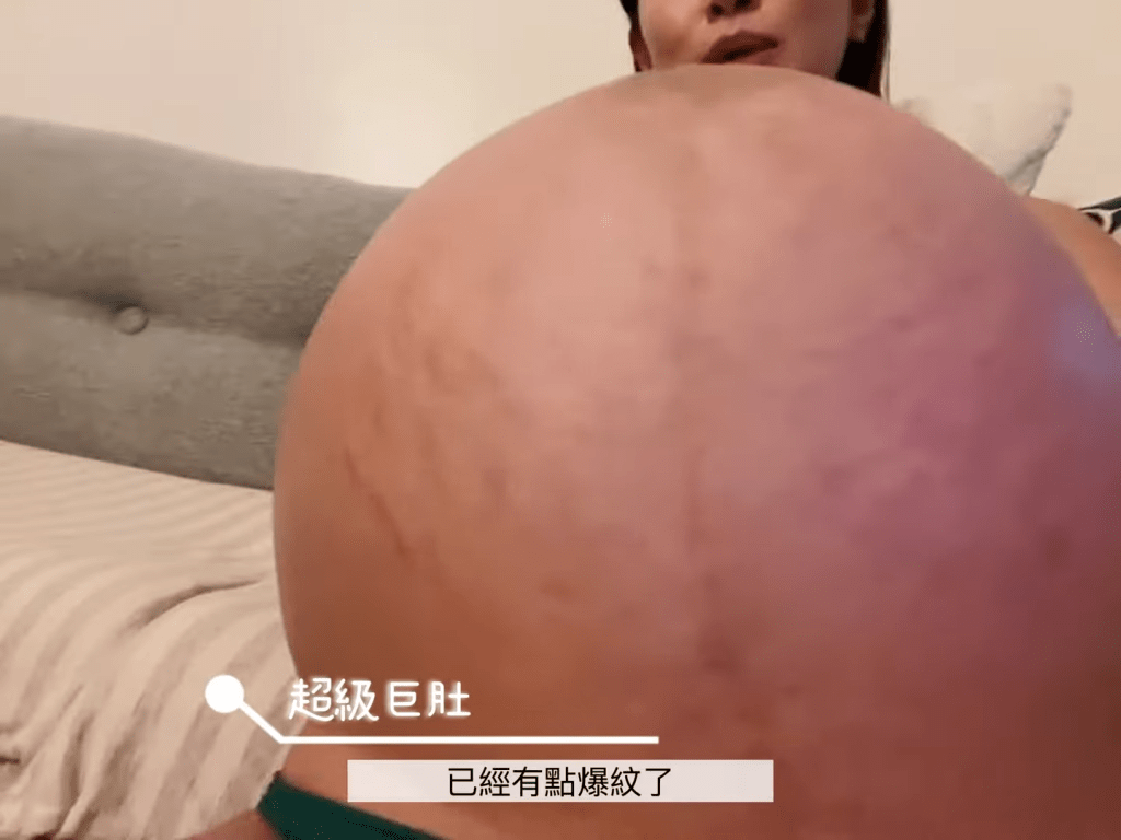 郭思琳表示胎儿很大，令肚子很大惊现妊娠纹。