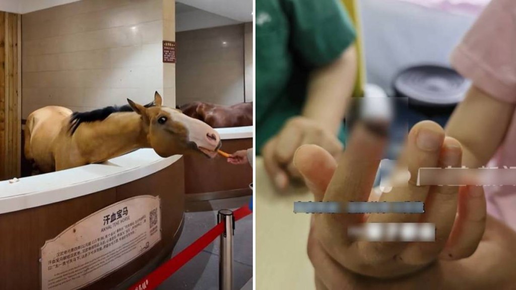 7歲王姓女童餵馬時被咬傷食指,整片指甲脫落。風芒新聞/抖音@中國馬鎮dj馬