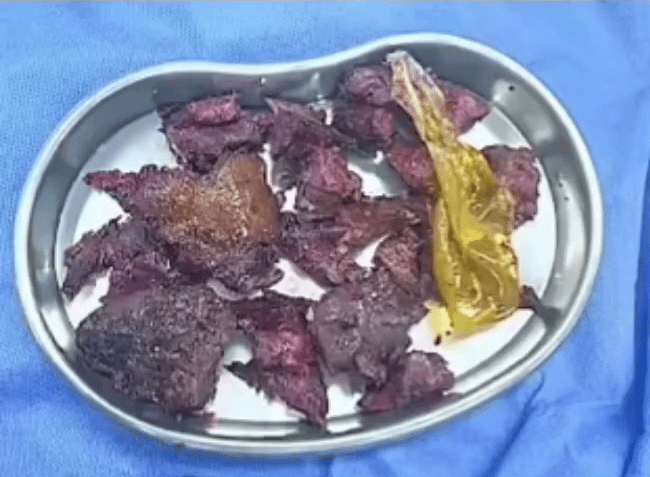 开刀取出捣碎的番薯。 开刀取出捣碎的番薯。