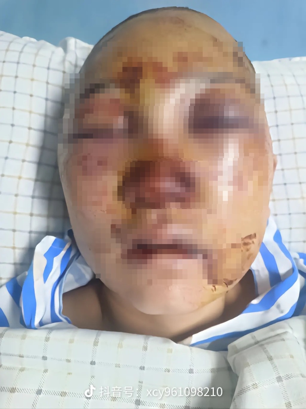 浙江女網紅臉部嚴重受傷。 抖音圖