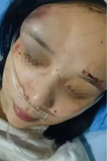 被虐打4小時的賴姓少女傷勢曝光。X 被虐打4小時的賴姓少女傷勢曝光。X