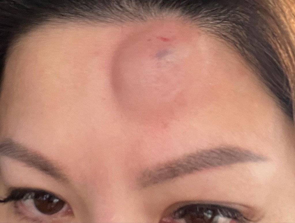 康子妮年初先貼出額頭紅腫Close up照。