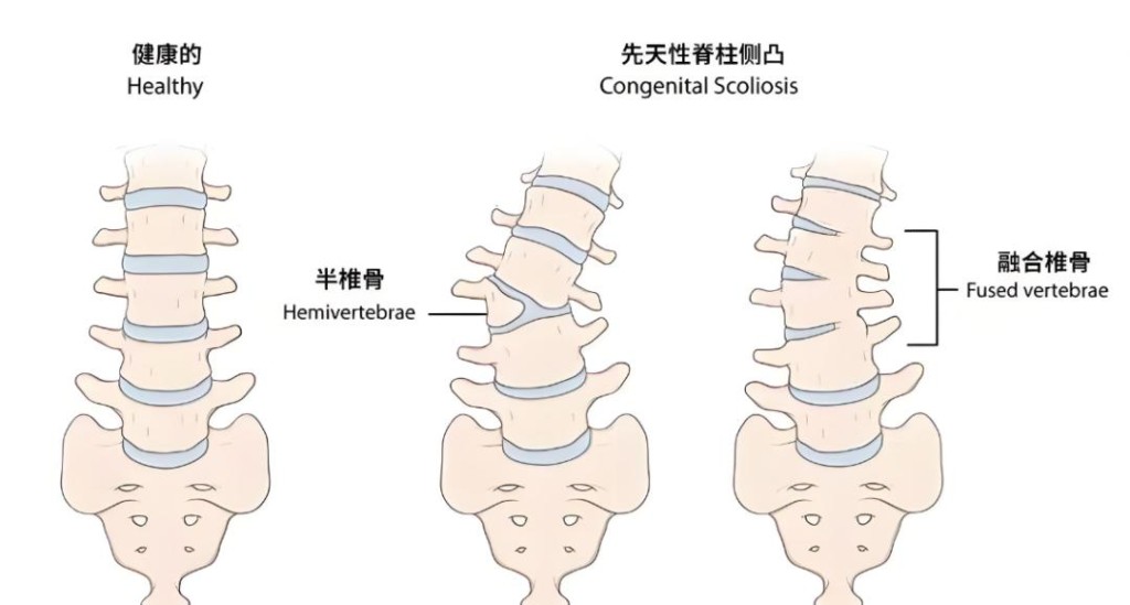 先天性脊柱側月凸。圖片由筆者提供