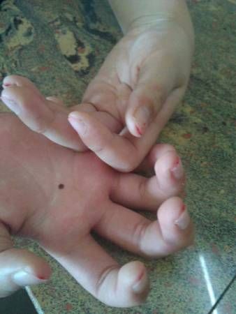 小學生被剪至十指流血。網上圖片