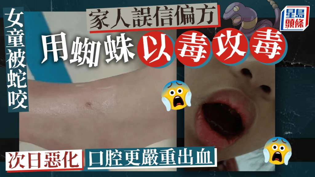 女童被蛇咬伤家人误信偏方用蜘蛛吸毒。网图
