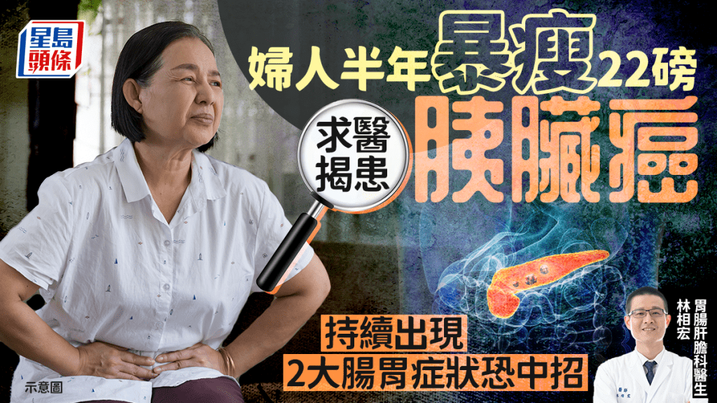 胰臟癌徵兆｜婦人半年暴瘦22磅 求醫揭患胰臟癌 持續出現2大腸胃症狀恐中招