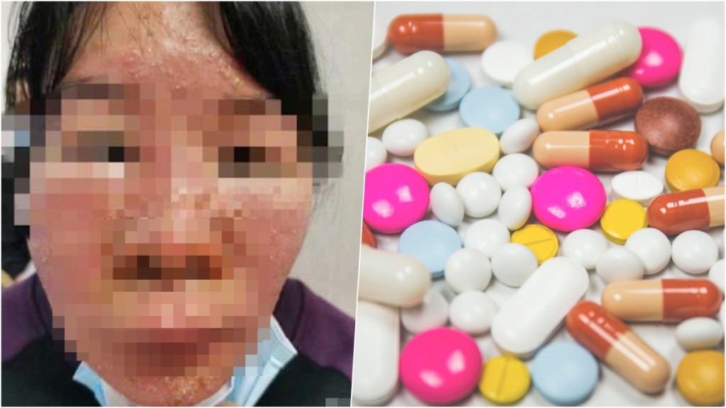 女子發現臉上出現紅斑、身上長滿膿瘡。網圖及unsplash圖