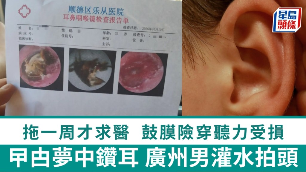 曱甴夢中鑽耳，廣州男灌水拍頭拖一周才求醫，鼓膜險穿聽力受損。