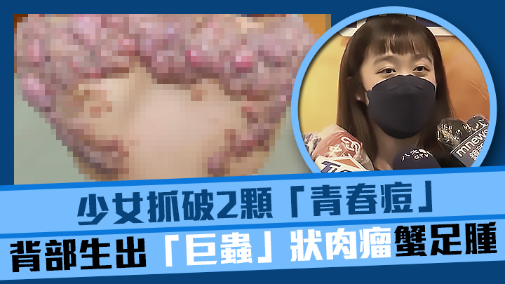 少女背部長出罕見巨大的「蟹足腫」。網上圖片