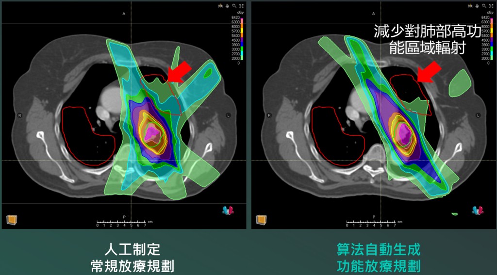 蔡璟教授及其團隊研發的人工智能肺部放射治療輔助系統,可自動分析肺癌患者的電腦掃描影像,分辨肺部不同區域的功能,設計個人化的最佳放射治療計劃,避開肺部高功能區域,以降低對患者肺部的放射損傷。 蔡璟教授及其團隊研發的人工智能肺部放射治療輔助系統,可自動分析肺癌患者的電腦掃描影像,分辨肺部不同區域的功能,設計個人化的最佳放射治療計劃,避開肺部高功能區域,以降低對患者肺部的放射損傷。