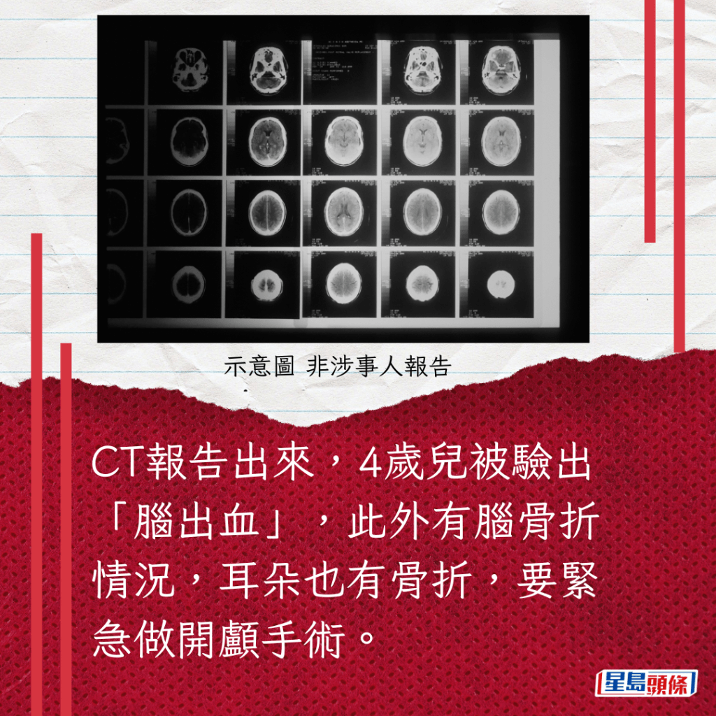 CT报告出来，4岁儿被验出「脑出血」，此外有脑骨折情况，耳朵也有骨折，要紧急做开颅手术。