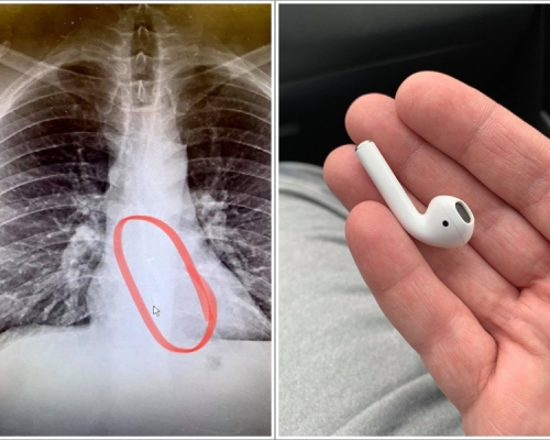 高斯特夢中將無線耳機吞下食道。fb
