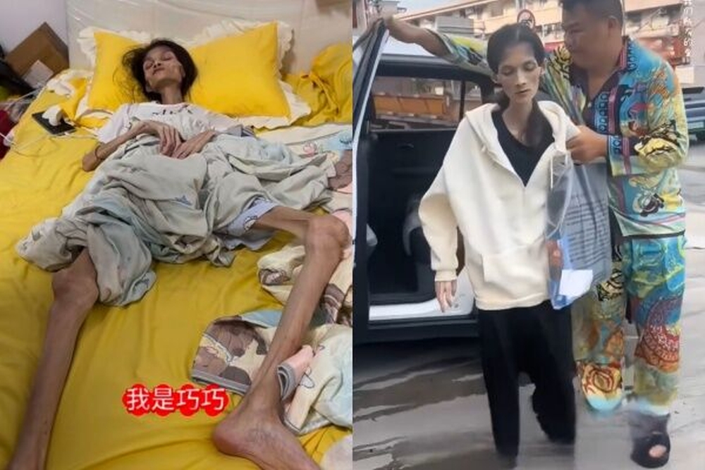 27岁女孩巧巧去世，此前她因患胃萎缩，体重仅剩17kg。