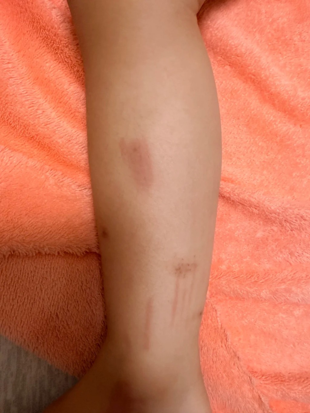 楊先生及女兒身體多處擦傷。 楊先生及女兒身體多處擦傷。
