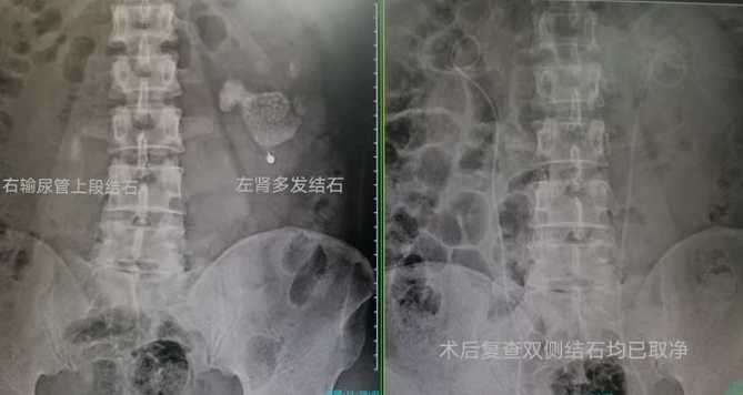 張男進行鏡碎石手術。網圖