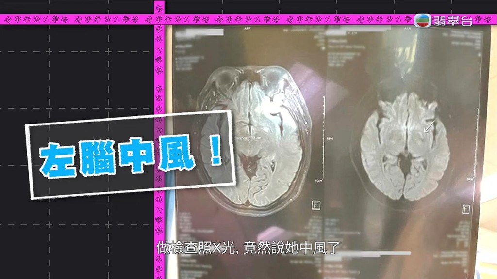 醫院磁力共振檢查證實葉小姐「左腦中風」,引致右側身體癱瘓。 醫院磁力共振檢查證實葉小姐「左腦中風」,引致右側身體癱瘓。