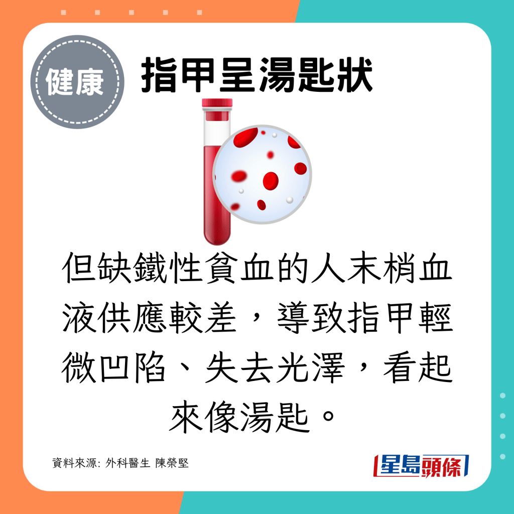 但缺鐵性貧血的人末梢血液供應較差,導致指甲輕微凹陷、失去光澤,看起來像湯匙。