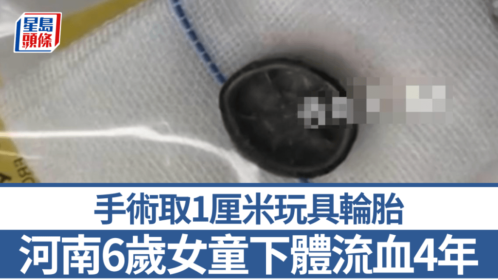 女童陰道藏玩具輪胎。都市報道