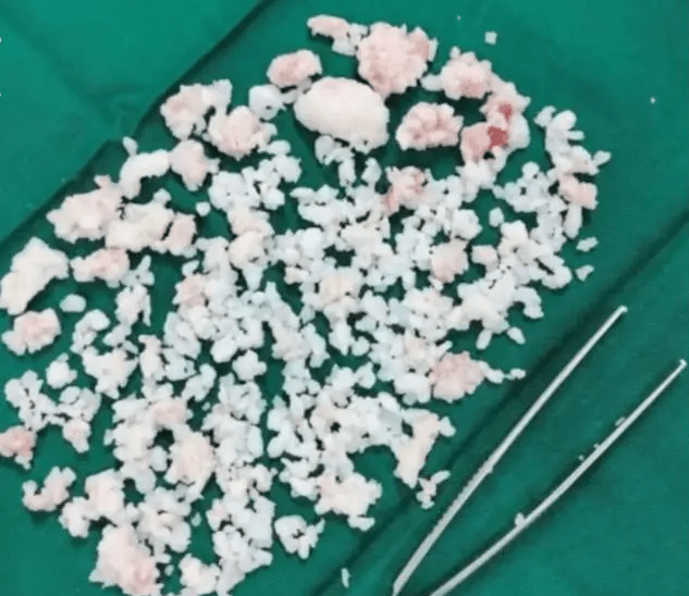 微創手術，取出了大量的滑膜軟骨瘤病灶（千餘顆外形看上去像「珍珠」的白色顆粒）。
