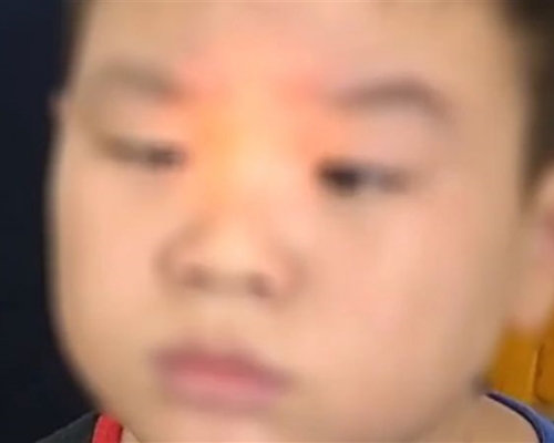 合肥一名9歲男童,因沉迷玩手機,導致雙眼變成「鬥雞眼」。 影片截圖