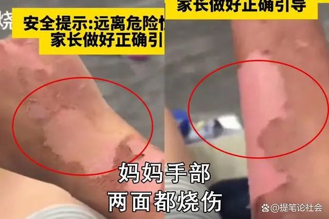 解開紗布清晰可見該名母親出現大面積脫皮現象。