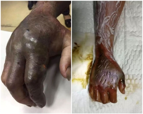 张男虽马上将毒血挤出，但右臂仍然瘀黑肿涨。网图