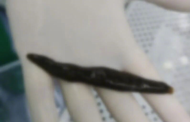 医生取出水蛭。《大河报》 医生取出水蛭。《大河报》